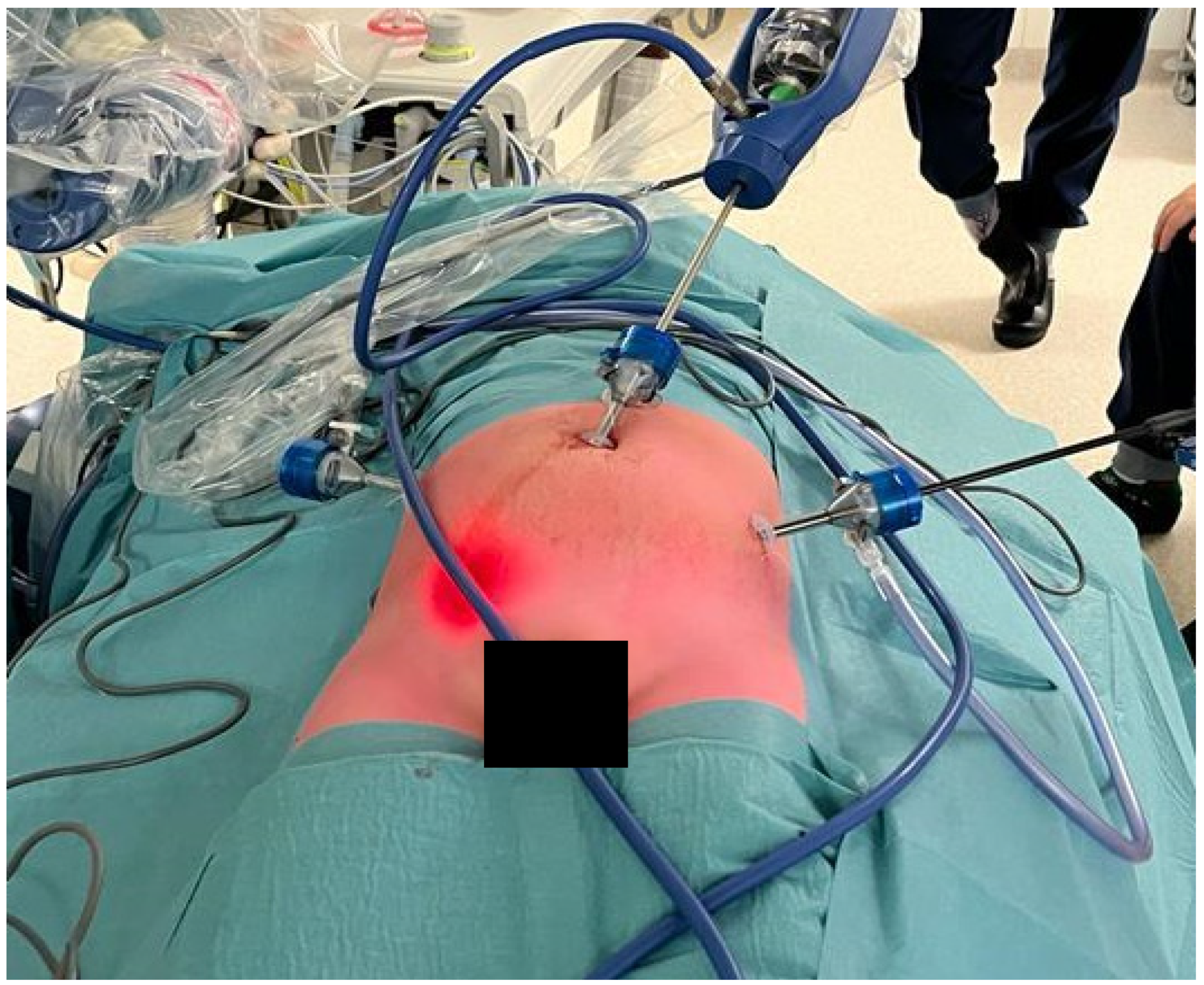 Robotic Hernia Surgery