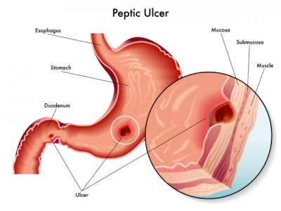 Upper Gastrointestinal Disease Image